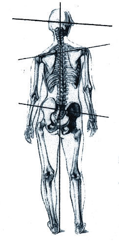 Ein deformiertes Skelett